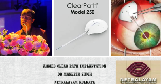 Surgical Technique & Insights | Dr. Maneesh Singh, Glaucoma & Cataract Consultant